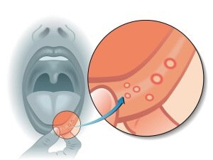 Kako liječiti afte - bolne ranice u ustima