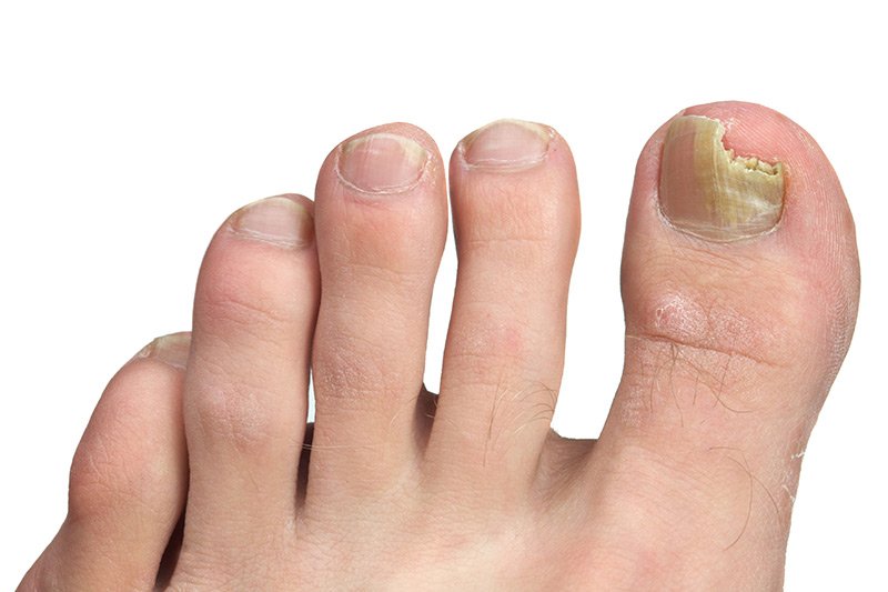 Gljivične infekcije na noktima