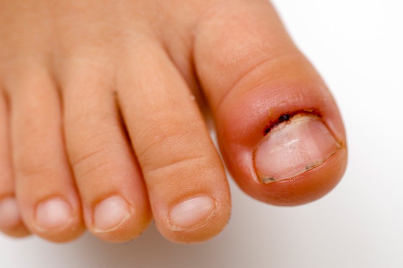 Paronihija – upala kože oko nokta