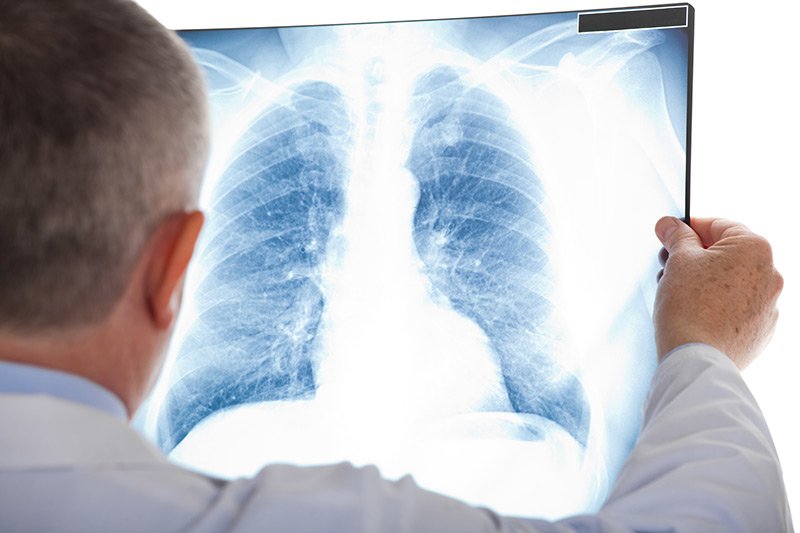 Plućna embolija i kako je liječiti